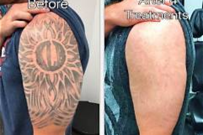 Best Tattoo Removal Doctor In Assam for Safe & Advanced Laser Tattoo Removal - Safe, Precise & Long-Lasting Results | Essence Skin Care