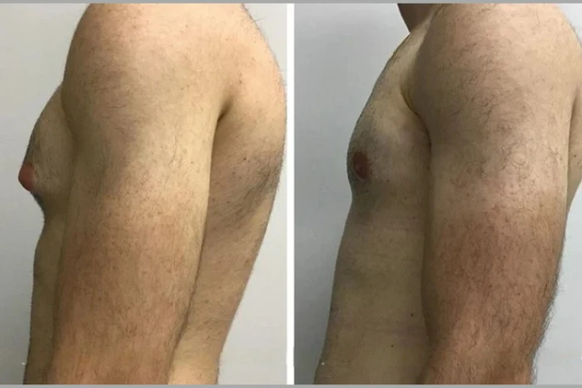 Best Gynecomastia Surgeon in Dubai: From Consultation to Confidence—A Complete Guide