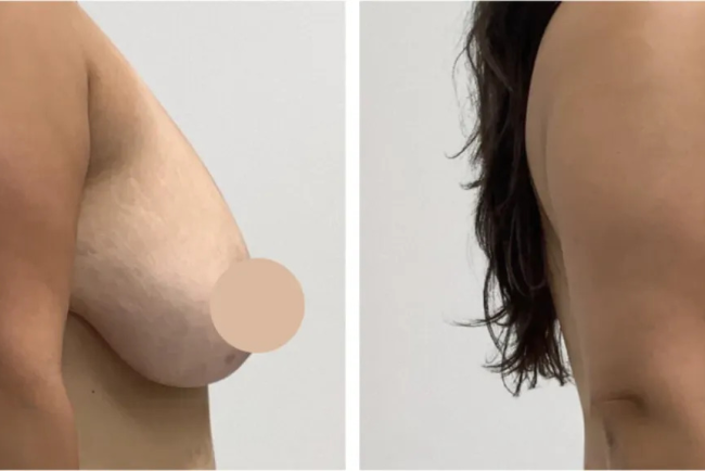 Breast Lift Surgery in Dubai for Artistic Breast Contouring