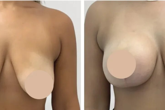 Breast Reduction in Dubai: Experience Customized Contouring With a Focus on Natural Results