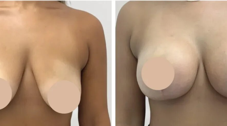 Breast Reduction Surgery in Dubai: Your Journey to a Lighter Feel