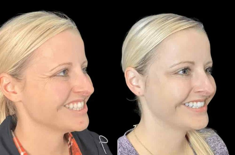 Best Plastic Surgeons in Dubai for Botox: How to Make an Informed Treatment Decision