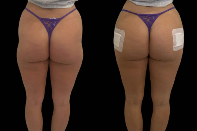 Hyacorp Fillers in Dubai for Enhanced Curves and Definition