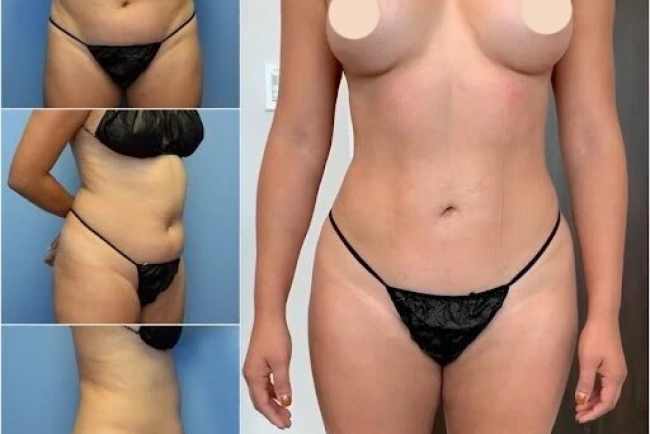Body Contouring in Dubai: Turn Your Body Goals into a Personalized Treatment Plan