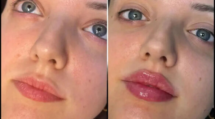 Fillers in Dubai for Fresh and Radiant Facial Appearance