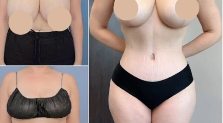Understanding How Tummy Tuck in Dubai Can Refine Your Body Contours
